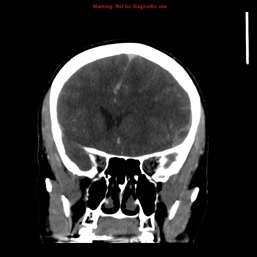 Cerebral venous infarction (Radiopaedia 12404-20735 B 26).jpg