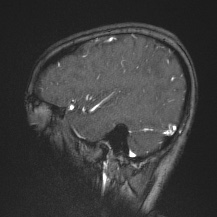 Cerebral venous infarction - hemorrhagic (Radiopaedia 81625-95505 Sagittal MRV 60).jpg