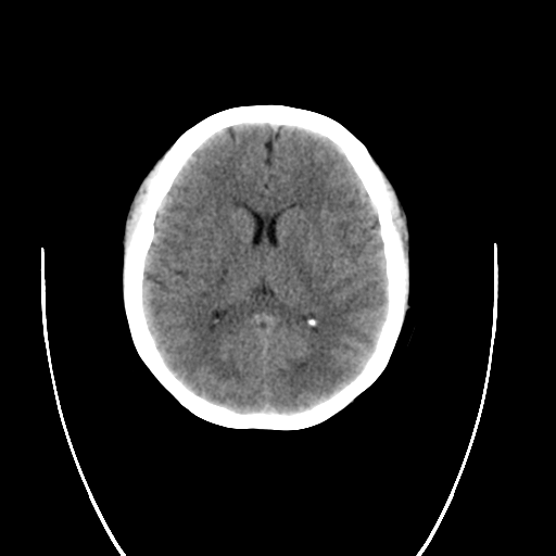 File:Cerebral venous infarction due to transverse sinus thrombosis (Radiopaedia 34688-36116 Coronal non-contrast 1).png