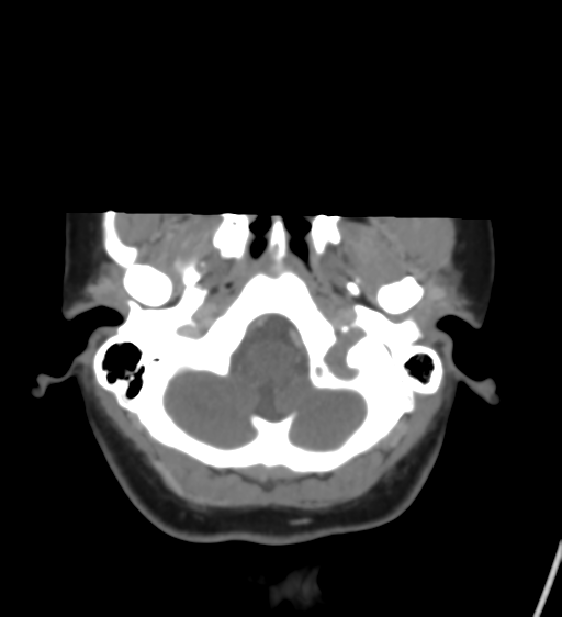 File:Cerebral venous infarction due to transverse sinus thrombosis (Radiopaedia 34688-36120 Axial CT venogram 9).png