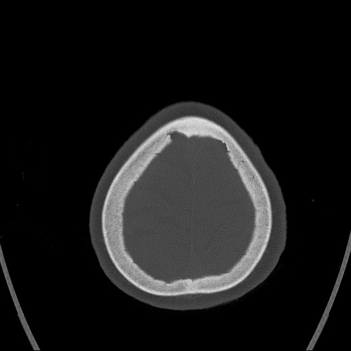 Cerebral venous infarction with hemorrhage (Radiopaedia 65343-74381 Axial bone window 173).jpg