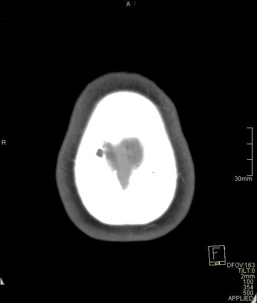 Cerebral venous sinus thrombosis (Radiopaedia 91329-108965 Axial venogram 75).jpg