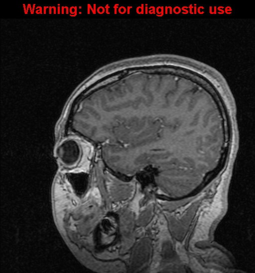 Cerebral venous thrombosis (Radiopaedia 37224-39208 Sagittal T1 C+ 40).jpg