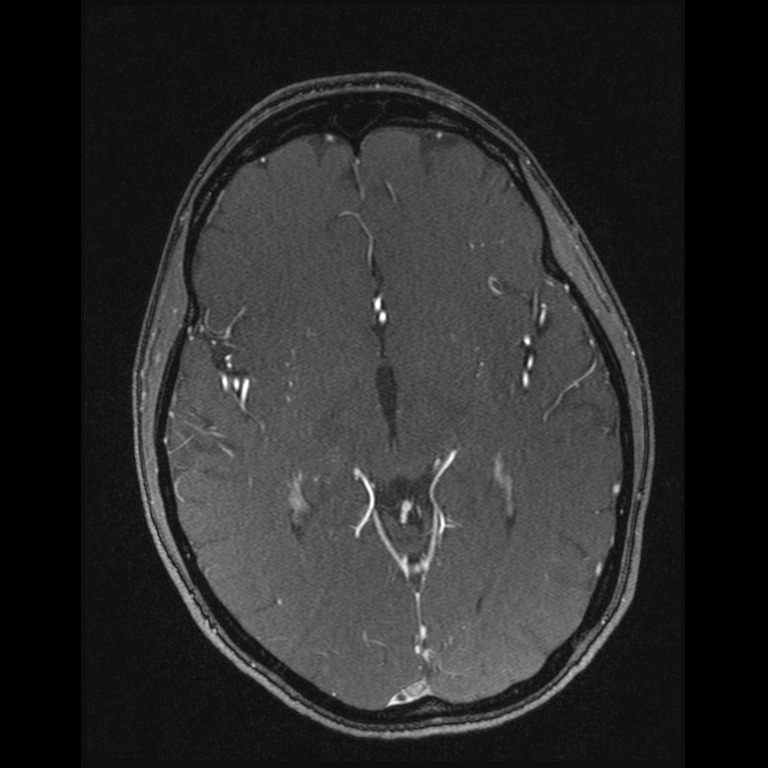 Cerebral venous thrombosis (Radiopaedia 45678-49854 Axial MRV 34).jpg