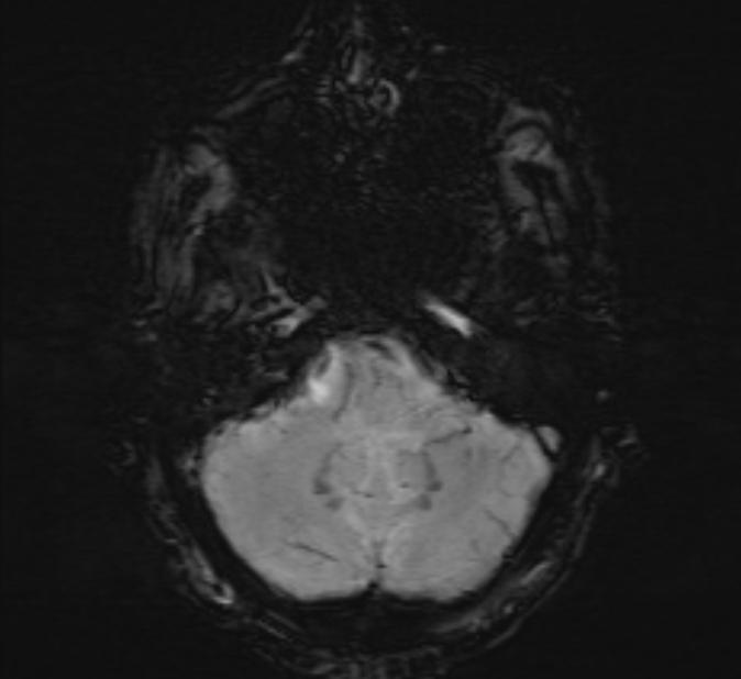 Cerebral venous thrombosis (Radiopaedia 71207-81504 Axial SWI 8).jpg
