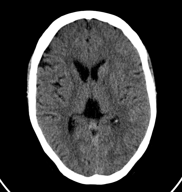 Cerebral venous thrombosis - CT only (Radiopaedia 41031-43778 Axial non-contrast 40).jpg