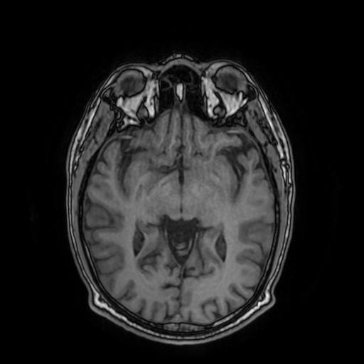 File:Cerebral venous thrombosis with secondary intracranial hypertension (Radiopaedia 89842-106957 Axial T1 87).jpg