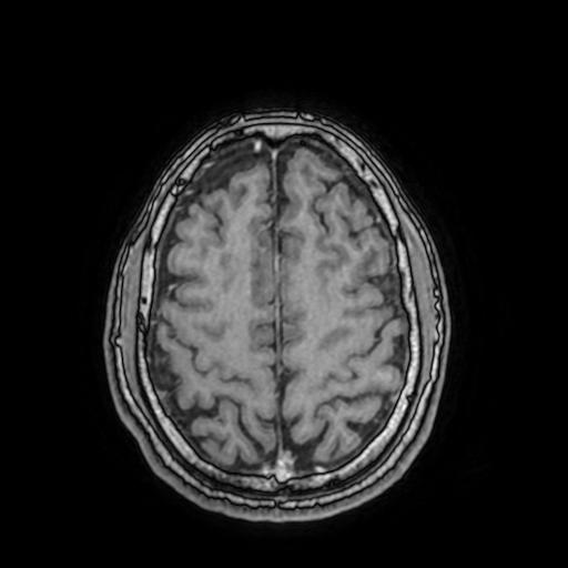 File:Cerebral venous thrombosis with secondary intracranial hypertension (Radiopaedia 89842-106957 Axial T1 C+ 132).jpg