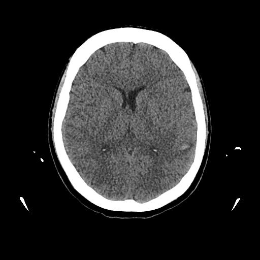 Cerebral venous thrombosis with venous hemorrhagic infarct (Radiopaedia 90354-107660 Axial non-contrast 28).jpg