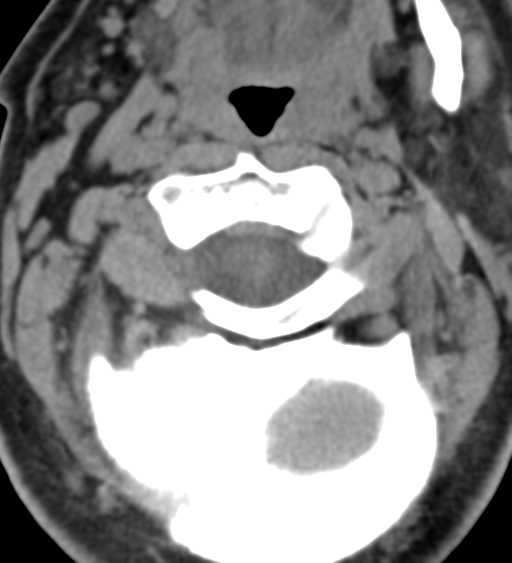 File:Cervical canal stenosis due to ossification of the posterior longitudinal ligament (Radiopaedia 47260-51823 Axial non-contrast 16).png
