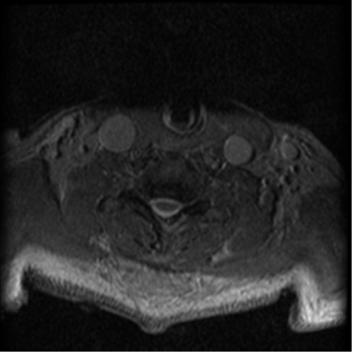 Cervical canal stenosis with cord compression (Radiopaedia 34114-35374 Axial Gradient Echo 24).png