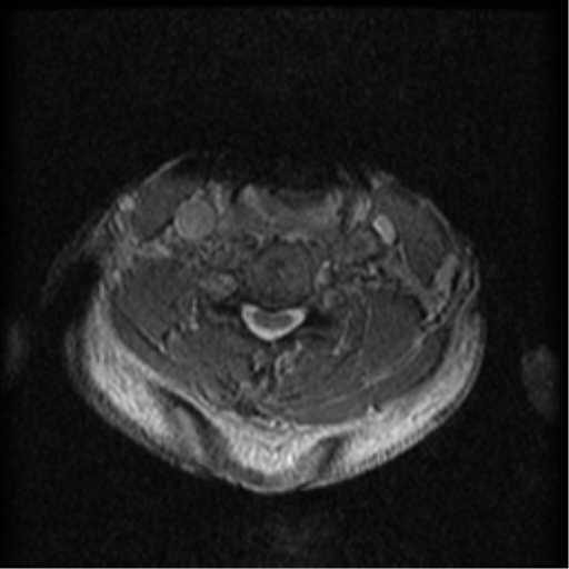 File:Cervical canal stenosis with cord compression (Radiopaedia 34114-35374 Axial Gradient Echo 40).png