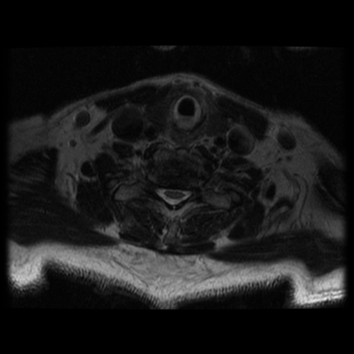 File:Cervical canal stenosis with cord compression (Radiopaedia 34114-35374 Axial T2 14).png