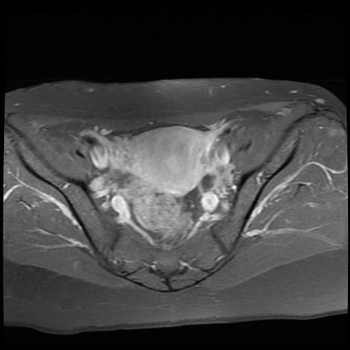 File:Cervical cancer (Radiopaedia 62991-71413 Axial T1 C+ fat sat 6).jpg