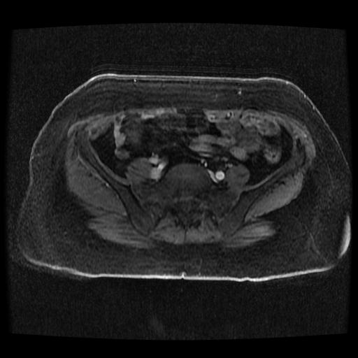 File:Cervical carcinoma (Radiopaedia 70924-81132 Axial T1 C+ fat sat 76).jpg