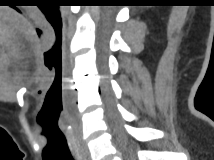 File:Cervical disc replacement (Radiopaedia 44025-47541 B 47).png
