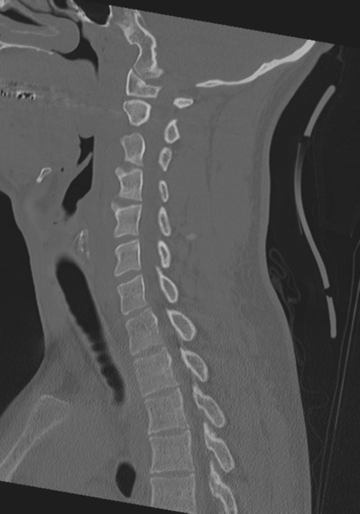 Cervical intercalary bone (Radiopaedia 35211-36748 Sagittal bone window 34).png