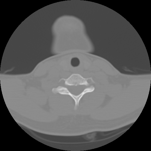 Cervical rib (Radiopaedia 71110-81363 Axial non-contrast 40).jpg