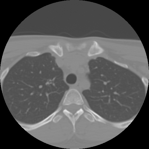 Cervical rib (Radiopaedia 71110-81363 Axial non-contrast 62).jpg