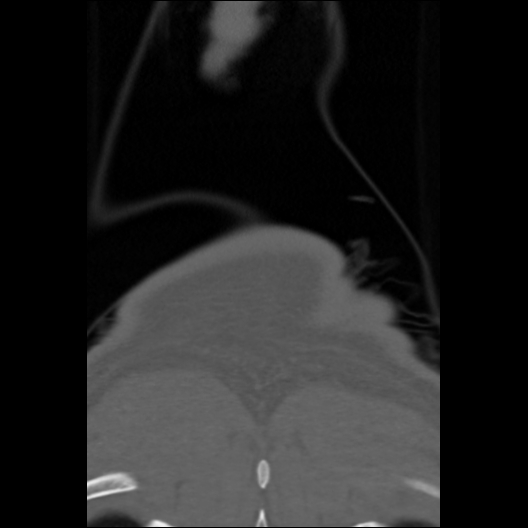 File:Cervical rib (Radiopaedia 71110-81363 Coronal non-contrast 2).jpg