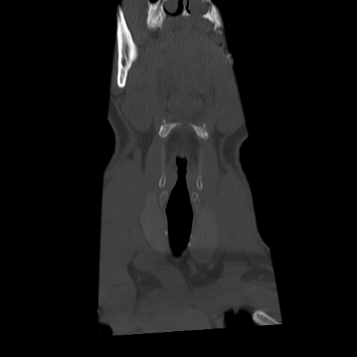 Cervical schwannoma (Radiopaedia 57979-64974 Coronal bone window 9).png
