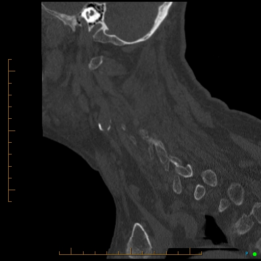 Cervical spine fracture - ankylosing spondylitis (Radiopaedia 76835-88706 Sagittal bone window 28).jpg