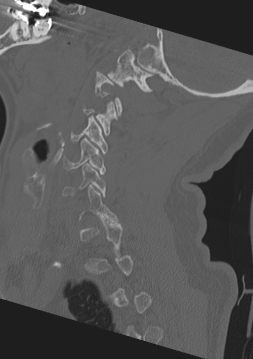 Cervical spine fractures with vertebral artery dissection (Radiopaedia 53296-59268 Sagittal bone window 19).png