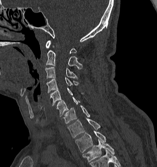 Cervical spine trauma with tear drop fracture and perched facet joint (Radiopaedia 53989-60127 Sagittal bone window 96).jpg