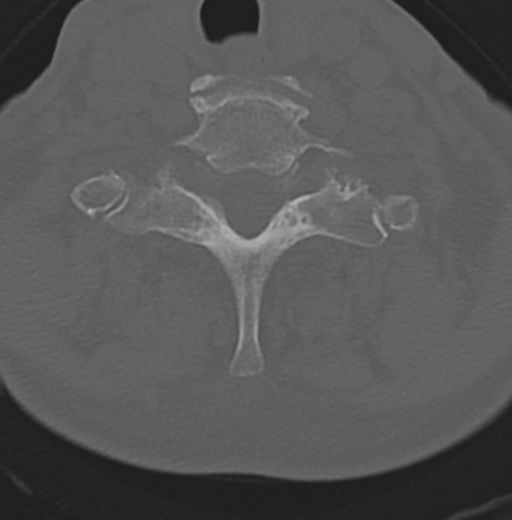 Cervical spondylolysis (Radiopaedia 49616-54811 Axial bone window 43).png
