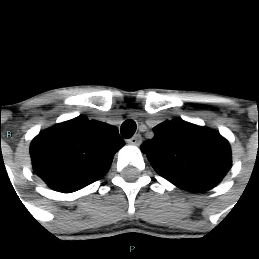 Cervical thymic cyst (Radiopaedia 88632-105335 Axial non-contrast 20).jpg