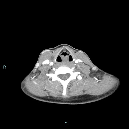 Cervical thymic cyst (Radiopaedia 88632-105335 B 48).jpg