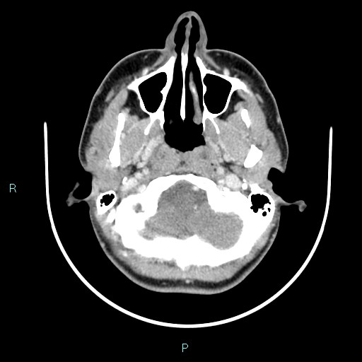 Cervical thymic cyst (Radiopaedia 88632-105335 C 102).jpg