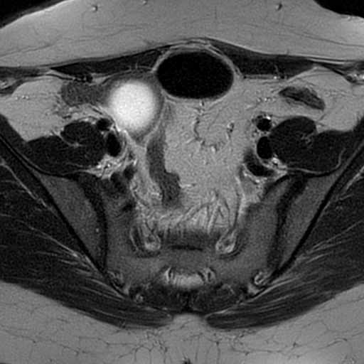 File:Cesarean scar ectopic pregnancy (Radiopaedia 77286-89362 Axial T2 14).jpg