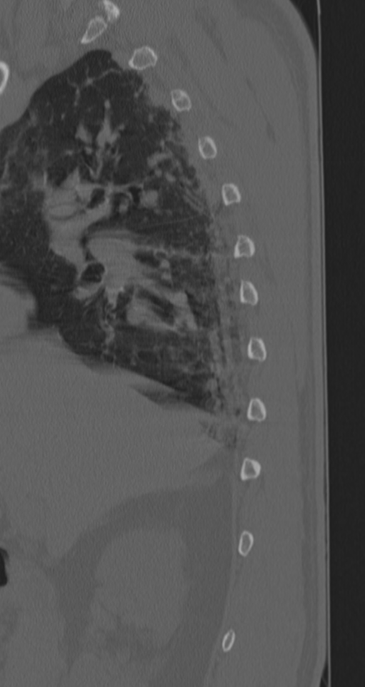 Chance fracture (Radiopaedia 33854-35020 Sagittal bone window 74).png