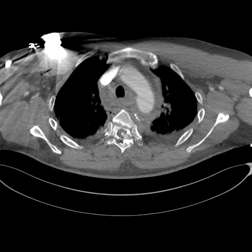 Chest multitrauma - aortic injury (Radiopaedia 34708-36147 A 87).png