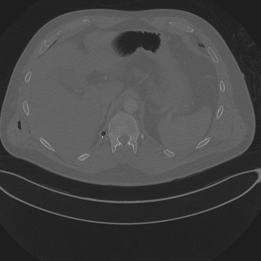 Chest multitrauma - aortic injury (Radiopaedia 34708-36147 Axial bone window 285).png
