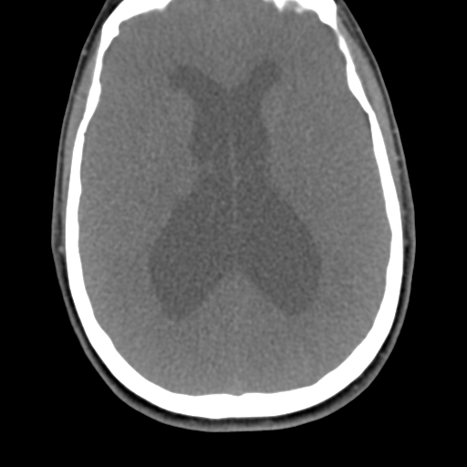 File:Chiari I malformation and obstructive hydrocephalus (Radiopaedia 41185-43981 D 7).png