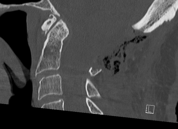 Chiari I malformation with a symptomatic syrinx of the posterolateral medulla oblongata (Radiopaedia 42573-45707 A 30).jpg