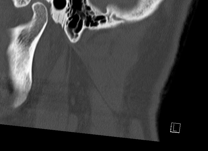 Chiari I malformation with a symptomatic syrinx of the posterolateral medulla oblongata (Radiopaedia 42573-45707 A 5).jpg