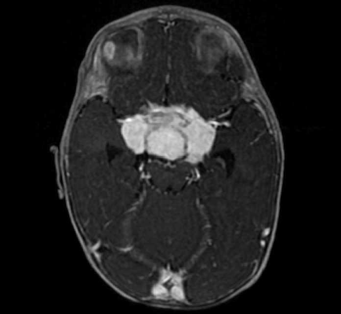 Chiasmatic-hypothalamic glioma (Radiopaedia 90079-107252 Axial T1 C+ 31).jpg