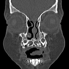 File:Choanal atresia (Radiopaedia 88525-105975 Coronal bone window 5).jpg
