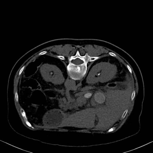 File:Cholecystitis - obstructive choledocholitiasis (CT intravenous cholangiography) (Radiopaedia 43966-47479 Axial 1).png