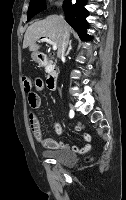 Cholecystoduodenal fistula due to calculous cholecystitis with gallstone migration (Radiopaedia 86875-103077 C 37).jpg