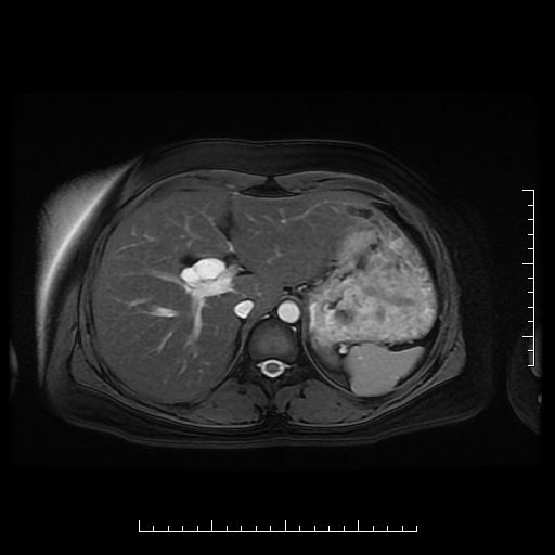 File:Choledochal cyst with chronic calcific pancreatitis (Radiopaedia 18245-18062 Axial T2 4).png