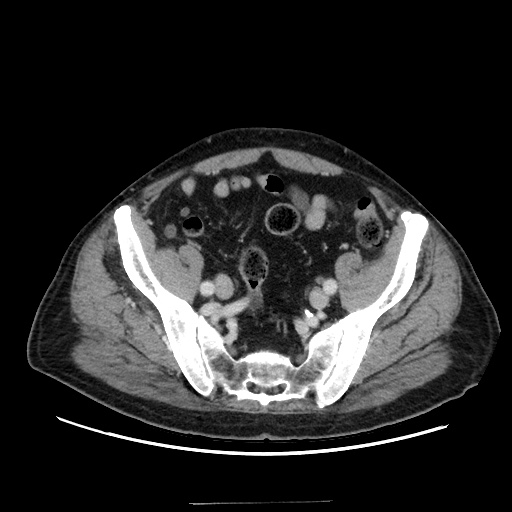 Choledocholiathiasis with normal caliber common bile duct (Radiopaedia 75368-86632 A 152).jpg