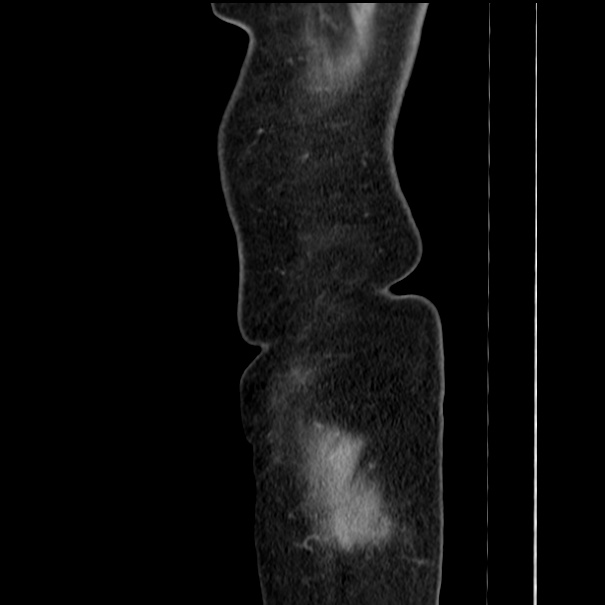 Choledocholithiasis on CT and MRI (Radiopaedia 24825-25087 D 63).jpg