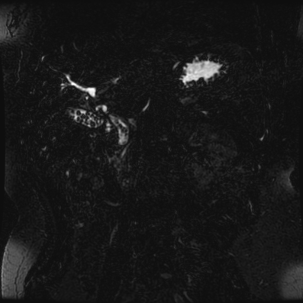 Choledocholithiasis on CT and MRI (Radiopaedia 24825-25088 Coronal T2 31).jpg