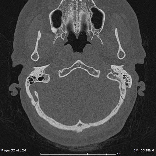 Cholesteatoma - external auditory canal (Radiopaedia 88452-105096 Axial bone window 18).jpg