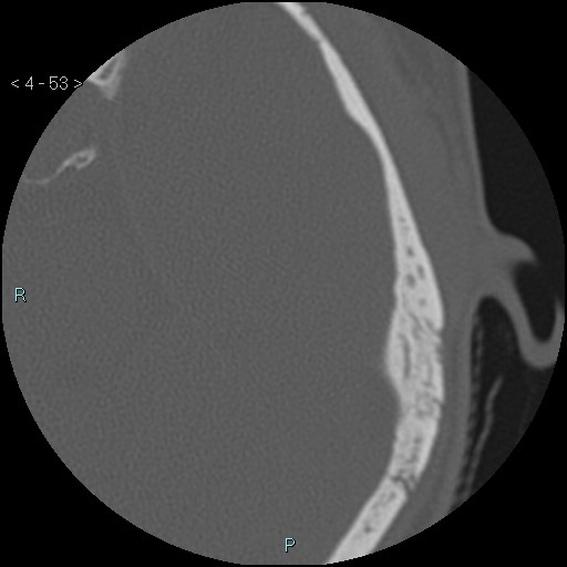 File:Cholesterol granuloma of the petrous apex (Radiopaedia 64358-73141 Axial bone window 26).jpg