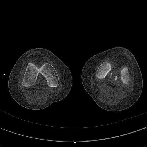 File:Chondroblastoma (Radiopaedia 62721-71030 Axial bone window 29).jpg
